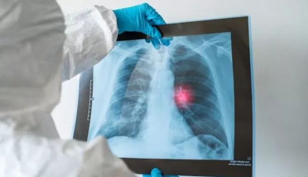 Las muertes por cáncer de pulmón en Indonesia superan las 30.000, las pruebas de detección y la detección temprana previenen